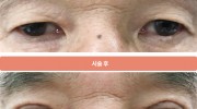 노인성 쌍꺼풀