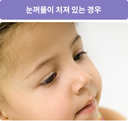 눈꺼풀이 쳐져있는 경우